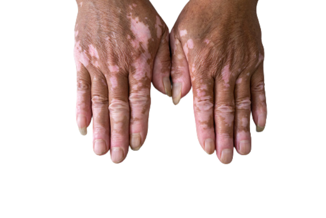 Vitiligo Treatment