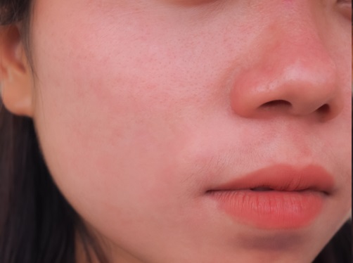 Acne Scar Treatment After