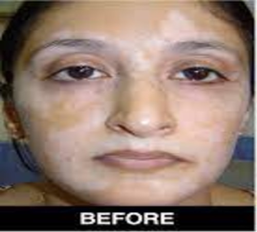 Vitiligo Treatment Before